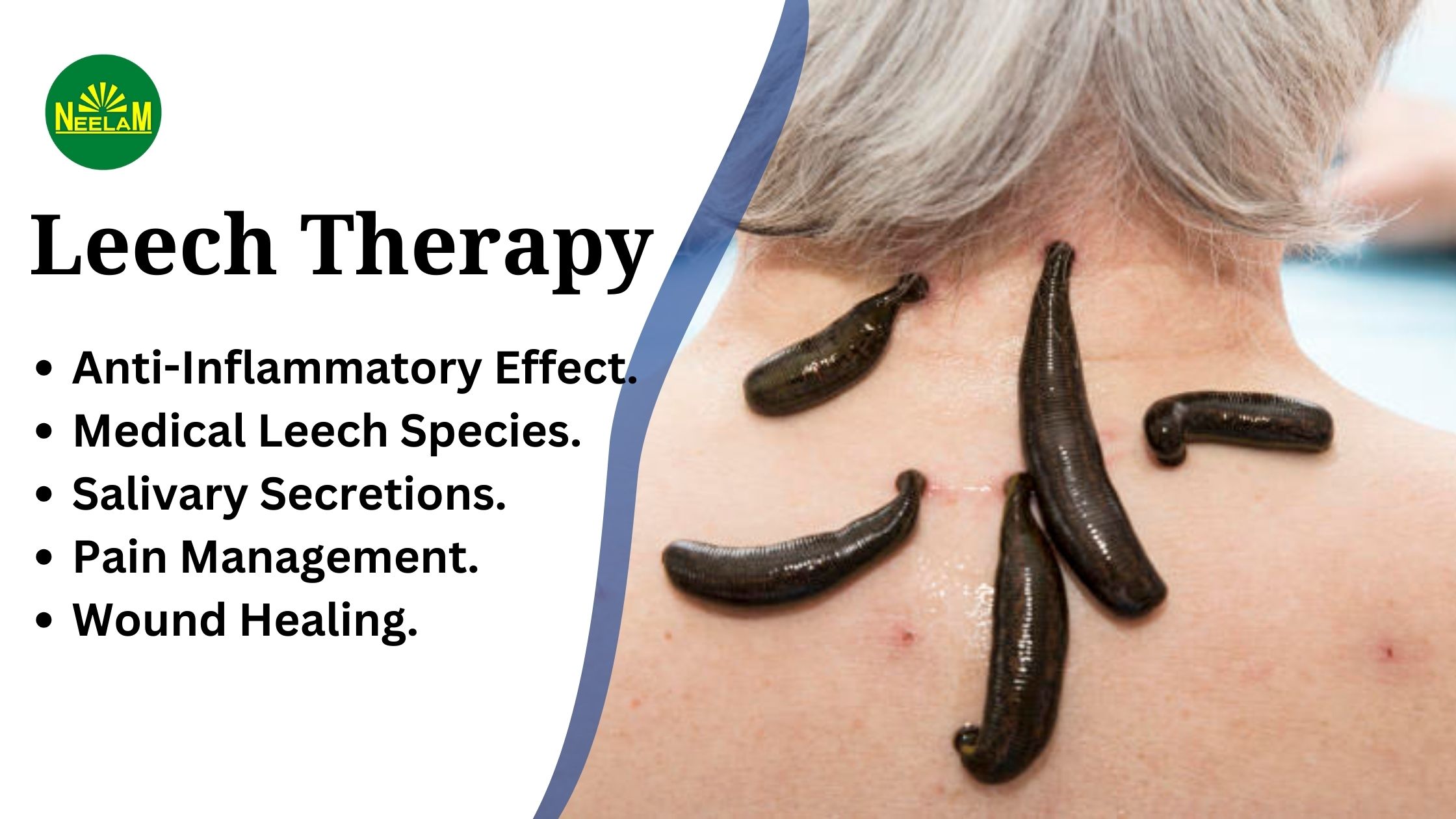 You are currently viewing What Is Leech Therapy?