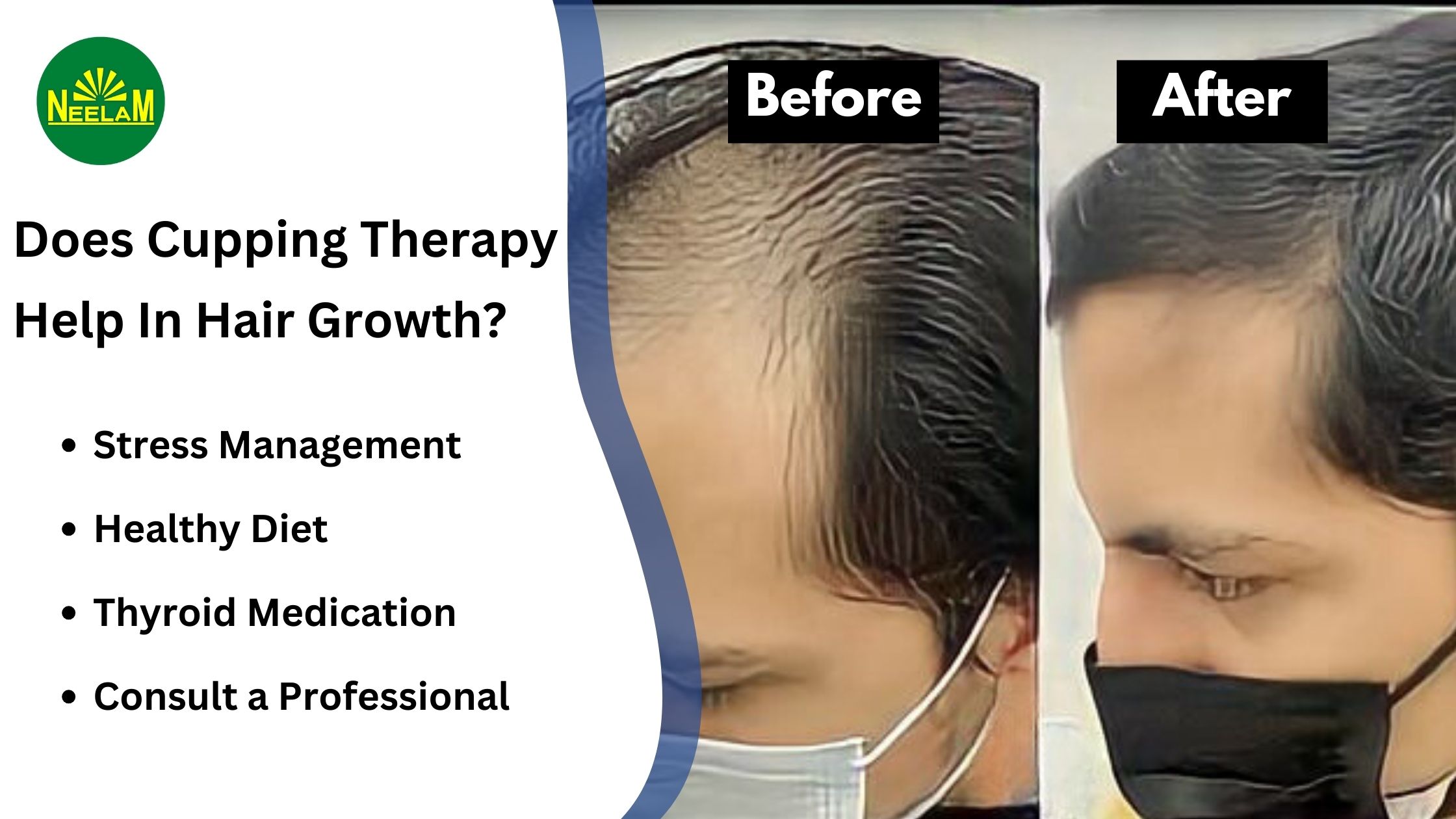 You are currently viewing Does Cupping Therapy Help In Hair Growth? 