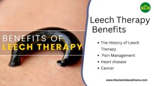 Read more about the article Leech Therapy Benefits