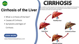 Read more about the article Cirrhosis of the Liver: Understanding the Silent Killer