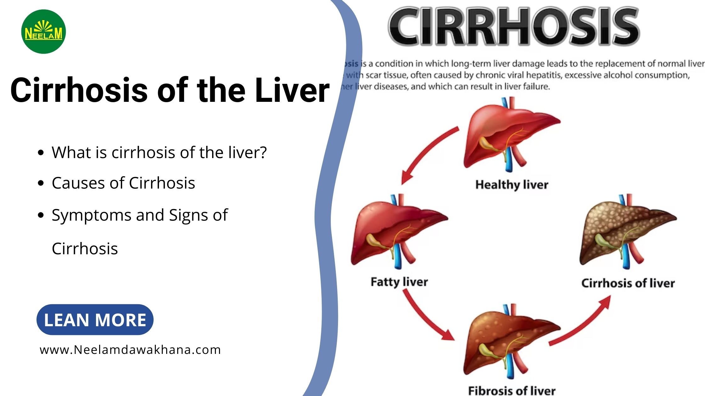 You are currently viewing Cirrhosis of the Liver: Understanding the Silent Killer