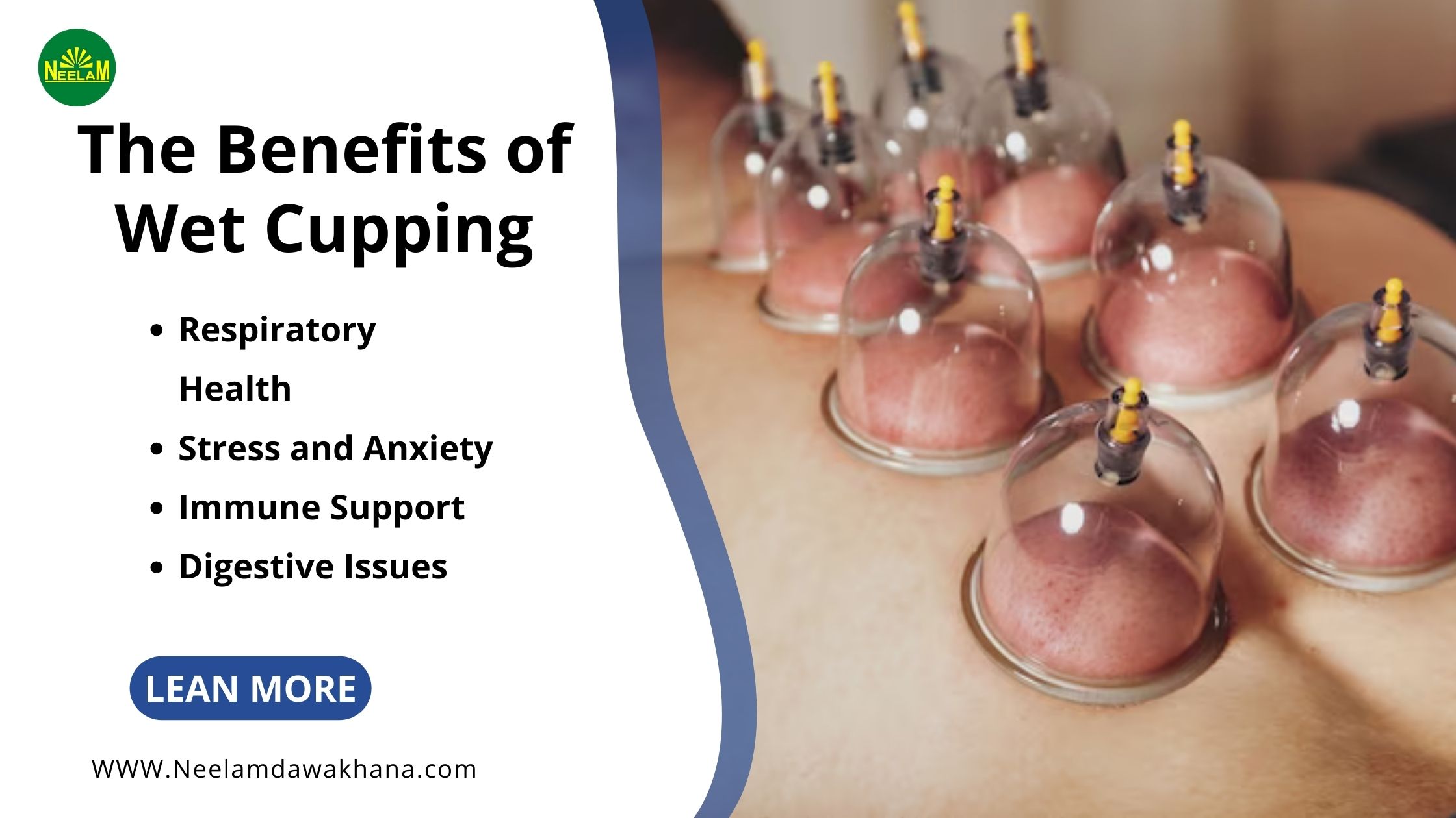 You are currently viewing Exploring The Benefits of Wet Cupping for Targeted Health Conditions: A Comprehensive Guide